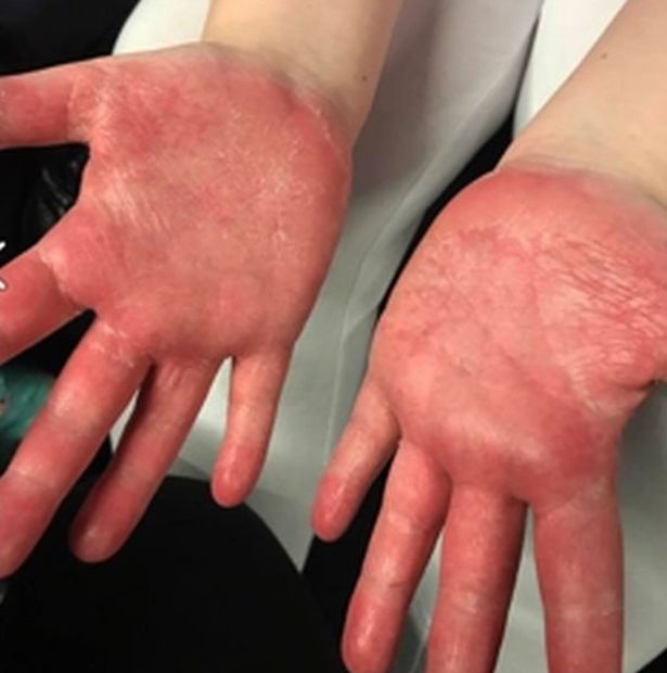 Chemical Burns In Work-Related Burn Injuries